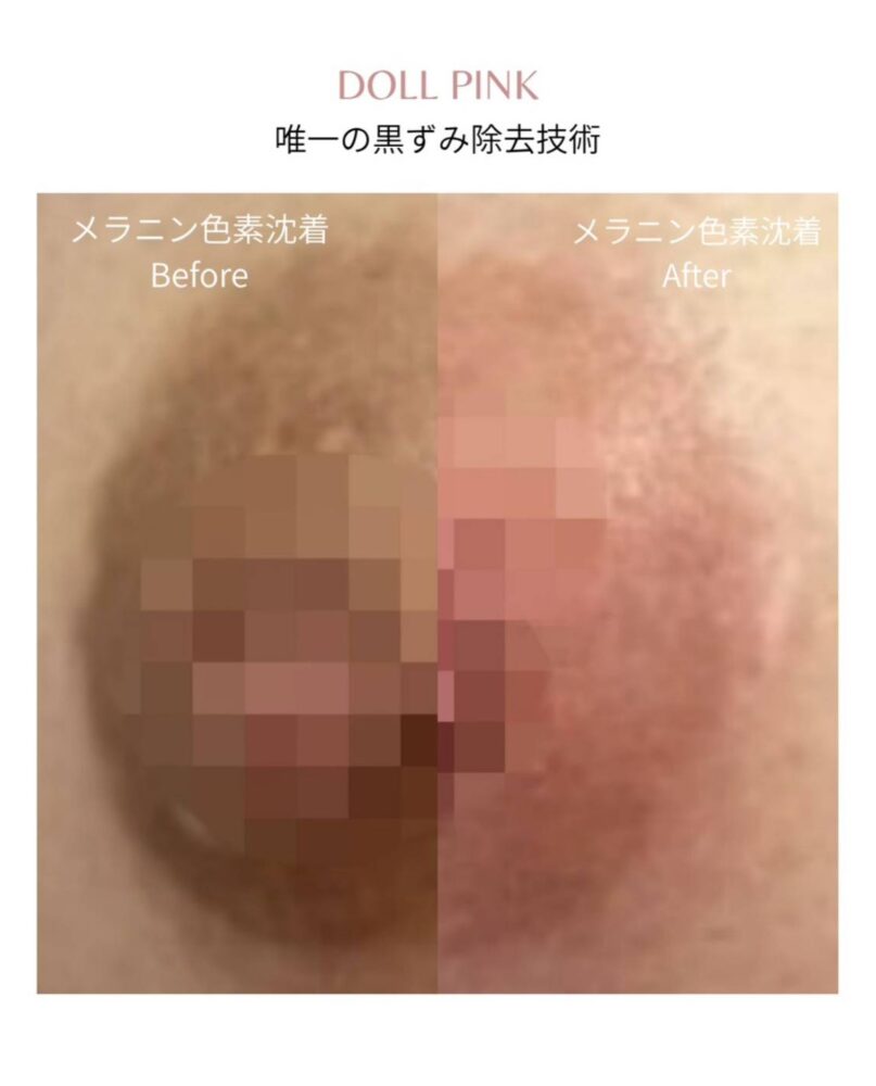 写真。唯一の黒ずみ除去技術。
メラニン色素沈着のBeforeとAfterを比べると色素の色が薄くなている。