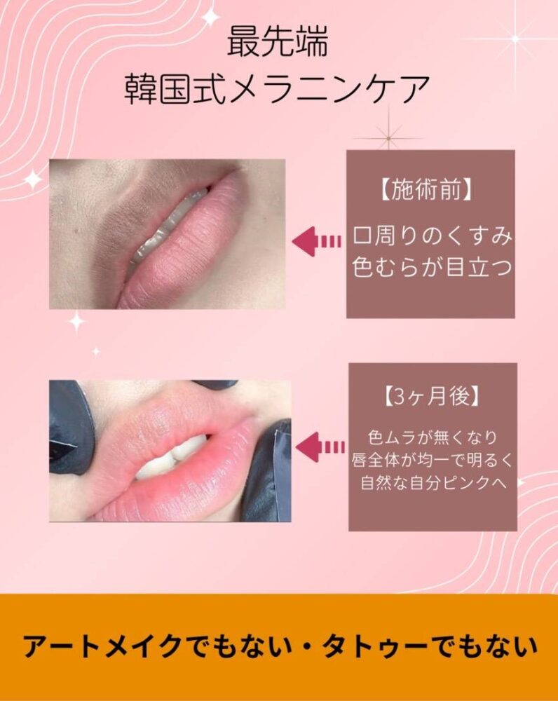 バナー。

アートでもない・タトゥーでもない最先端韓国式メラニンケア。施術前は口周りのくすみ、色むらが目立っているのに対し、３ヶ月後は色ムラが無くなり、唇全体が均一で明るく自然な自分ピンクへ。

